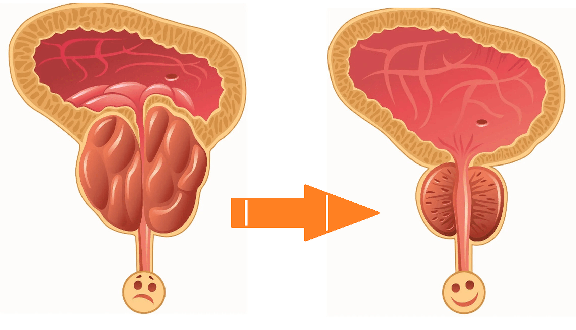 Effet de Uromexil Forte sur la prostate avec prostatite et adénome