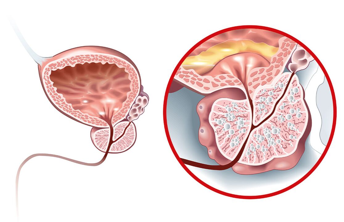 Qu'arrive-t-il à la prostate en cas d'adénome et de prostatite